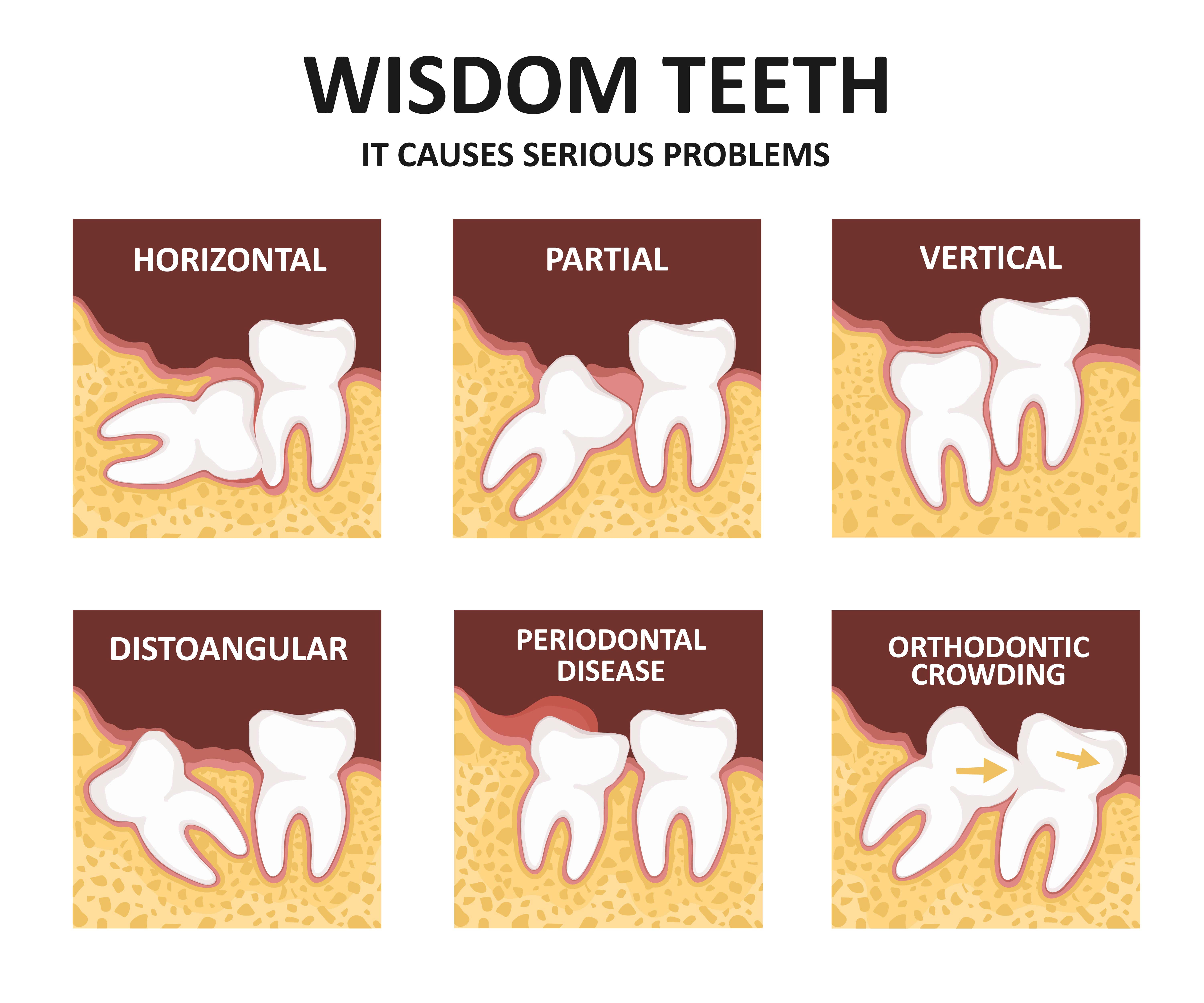 Wisdom Teeth Problems